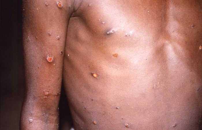 OMS declara emergência global de saúde para tentar conter surto de varíola do macaco